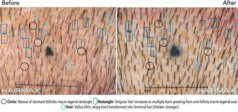 תוצאות קליניות של עצירת נשירה וצמיחה מחודשת של שיער