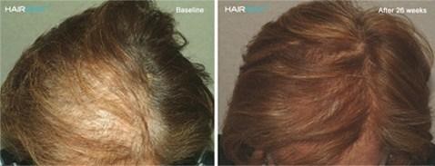 תוצאות שימוש בהיירמקס במחקר קליני למניעת נשירה והצמחת שיער