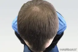 שיקום שיער ועצירת נשירה אחרי שימוש במכשיר היירמקס 
