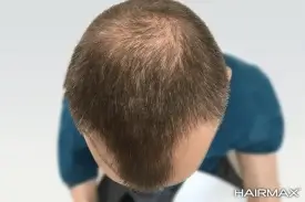  נשירת שיער לפני שימוש במכשיר היירמקס 