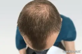  נשירת שיער לפני שימוש במכשיר היירמקס גרירת התמונה בעזרת העכבר תראה את התוצאה הסופית